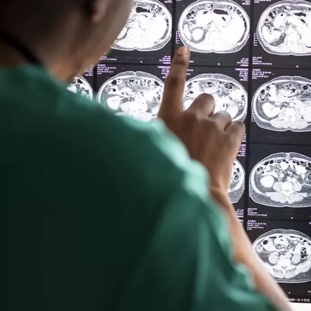 Treatment of brain gliomas Treatment of brain gliomas