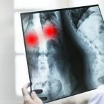 Fracturas vertebrales en Costa Rica: opciones sin cirugía